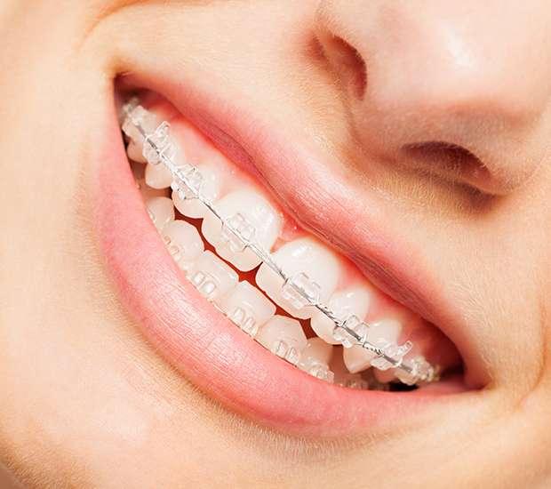 Peoria Clear Braces