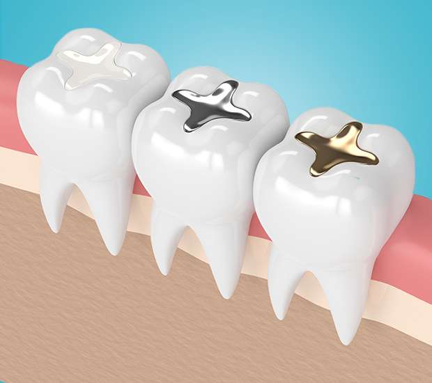 Peoria Composite Fillings