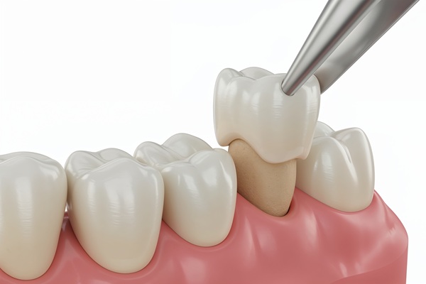 Does Dental Insurance Cover Dental Crowns?