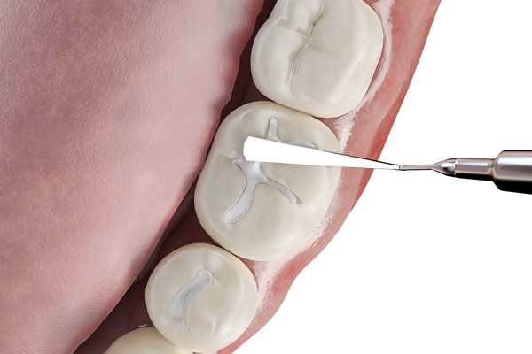 Dental Filling For A Cavity