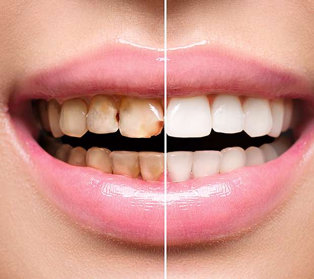 Peoria Dental Implant Restoration