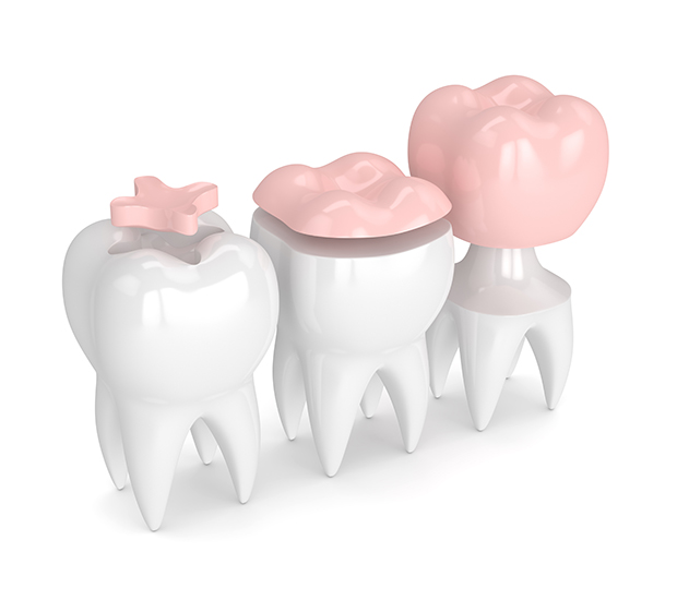 Peoria Dental Inlays and Onlays