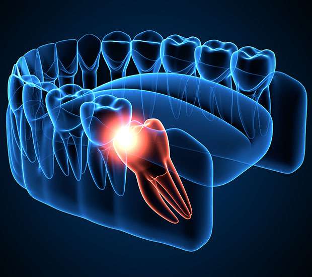 Peoria Wisdom Teeth Extraction